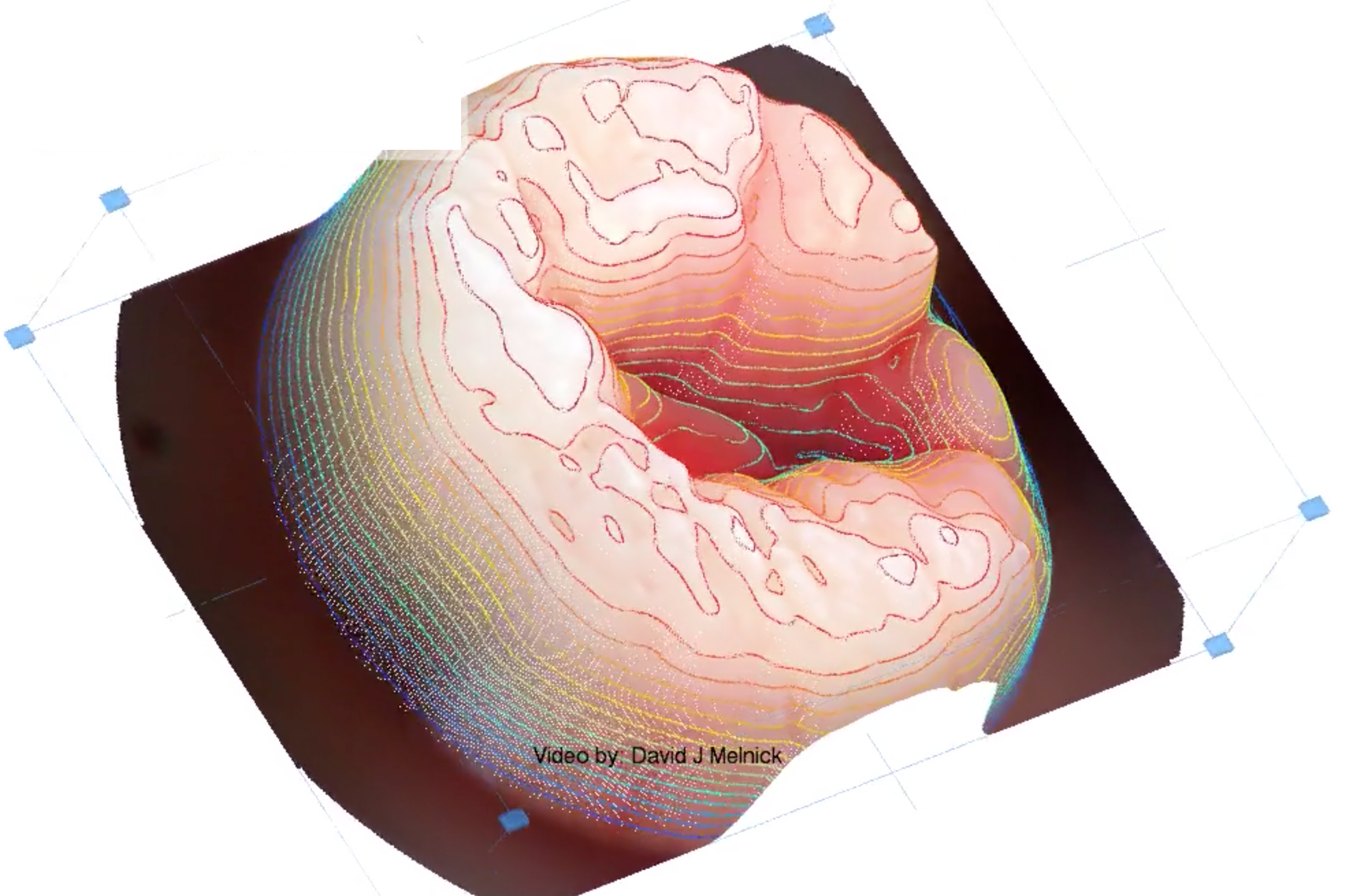 3D image of cervix